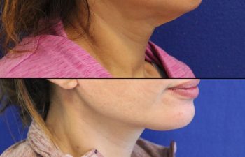 46 year-old patient before and after two weeks after a mini neck lift