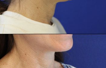 52 year-old before and after mini facelift, mini neck lift and TCA peel
