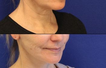 56 year-old patient before and two weeks after mini facelift, mini neck lift and TCA peel