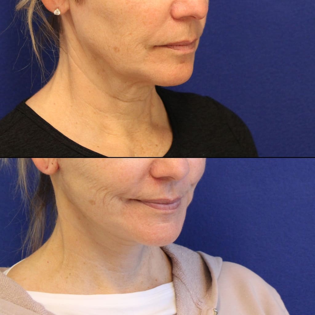 56 year-old patient before and two weeks after mini facelift, mini neck lift and TCA peel