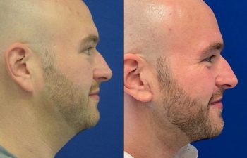 Our 33 year-old patient was concerned with the appearance of his neck despite weight loss and exercise. Dr. Maia performed a mini neck lift and neck liposuction to achieve the appearance he was looking for. Scars will fade away over time