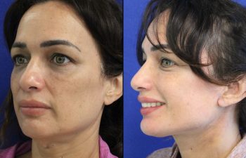 46 year-old patient before and after two weeks after a mini neck lift