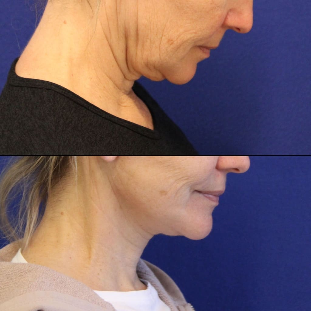 56 year-old patient before and two weeks after mini facelift, mini neck lift and TCA peel