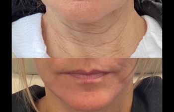 pictures taken by own patient before and after mini facelift, mini neck lift and TCA peel