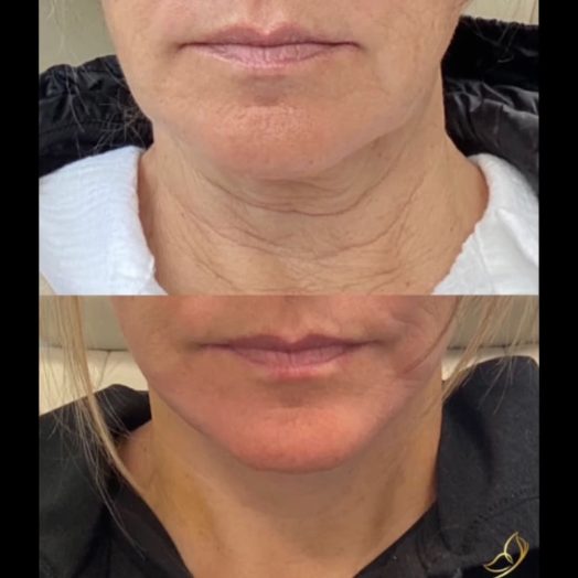 pictures taken by own patient before and after mini facelift, mini neck lift and TCA peel