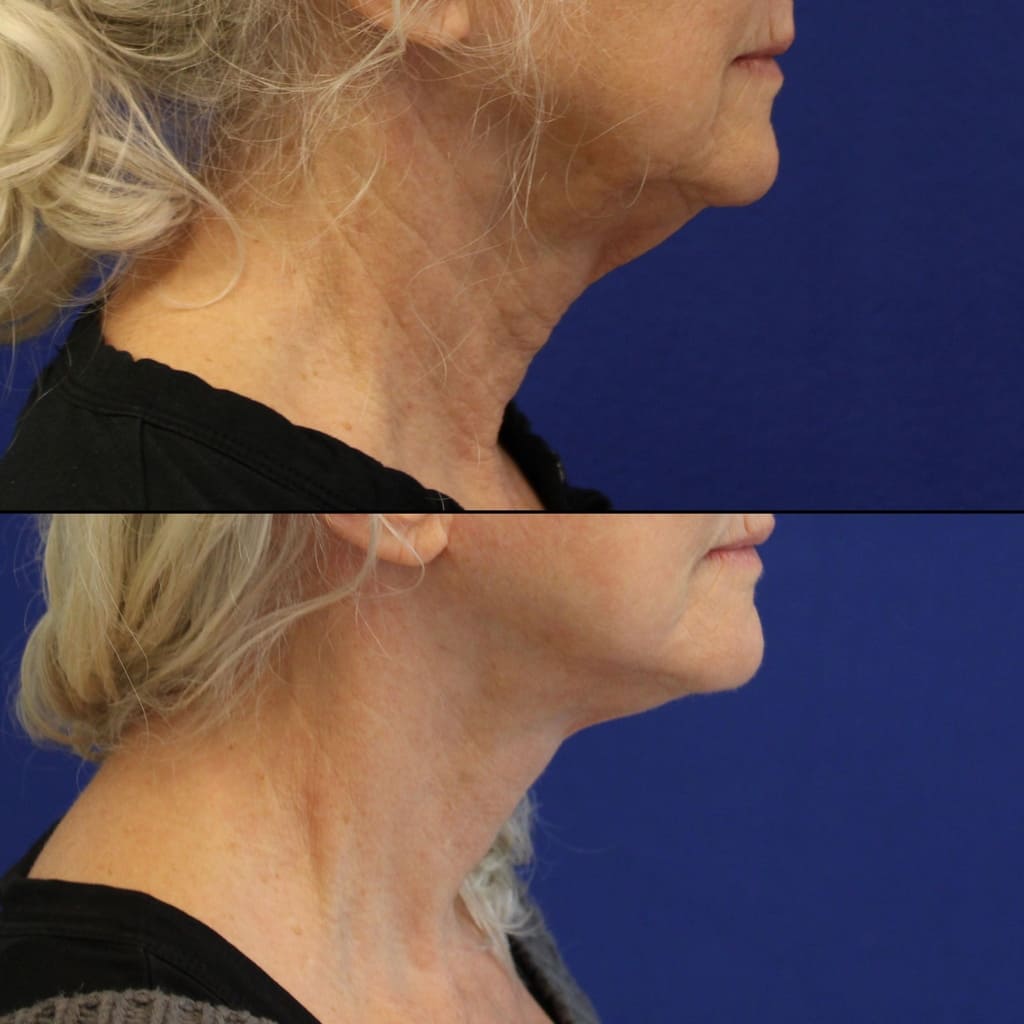 71 year old before and after facelift, neck lift, upper and lower blepharoplasty, canthopexy, fat grafting and TCA peel