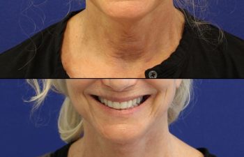 71 year old before and after facelift, neck lift, upper and lower blepharoplasty, canthopexy, fat grafting and TCA peel