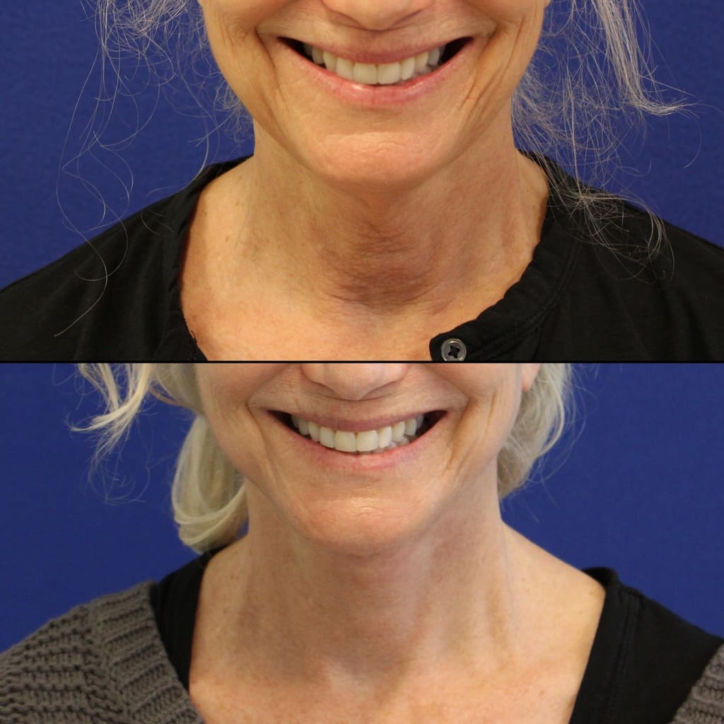 71 year old before and after facelift, neck lift, upper and lower blepharoplasty, canthopexy, fat grafting and TCA peel