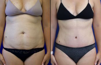41 year-old patient before and after abdominoplasty and flanks liposuction