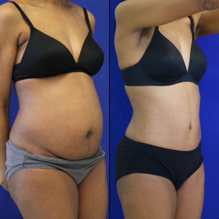 53 year-old patient before and after-abdominoplasty and flanks liposuction.