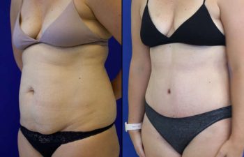 41 year-old patient before and after abdominoplasty and flanks liposuction