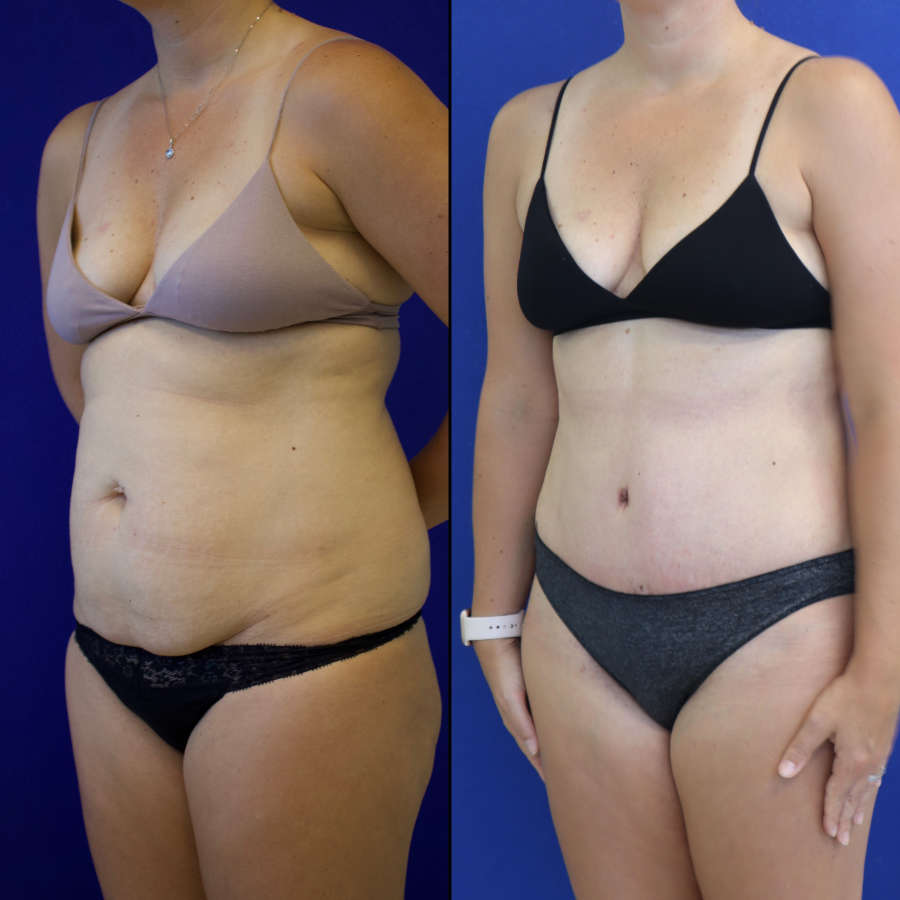 41 year-old patient before and after abdominoplasty and flanks liposuction