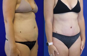 41 year-old patient before and after abdominoplasty and flanks liposuction