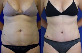 41 year-old patient before and after abdominoplasty and flanks liposuction.