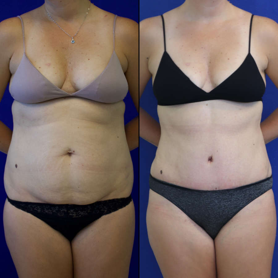41 year-old patient before and after abdominoplasty and flanks liposuction.