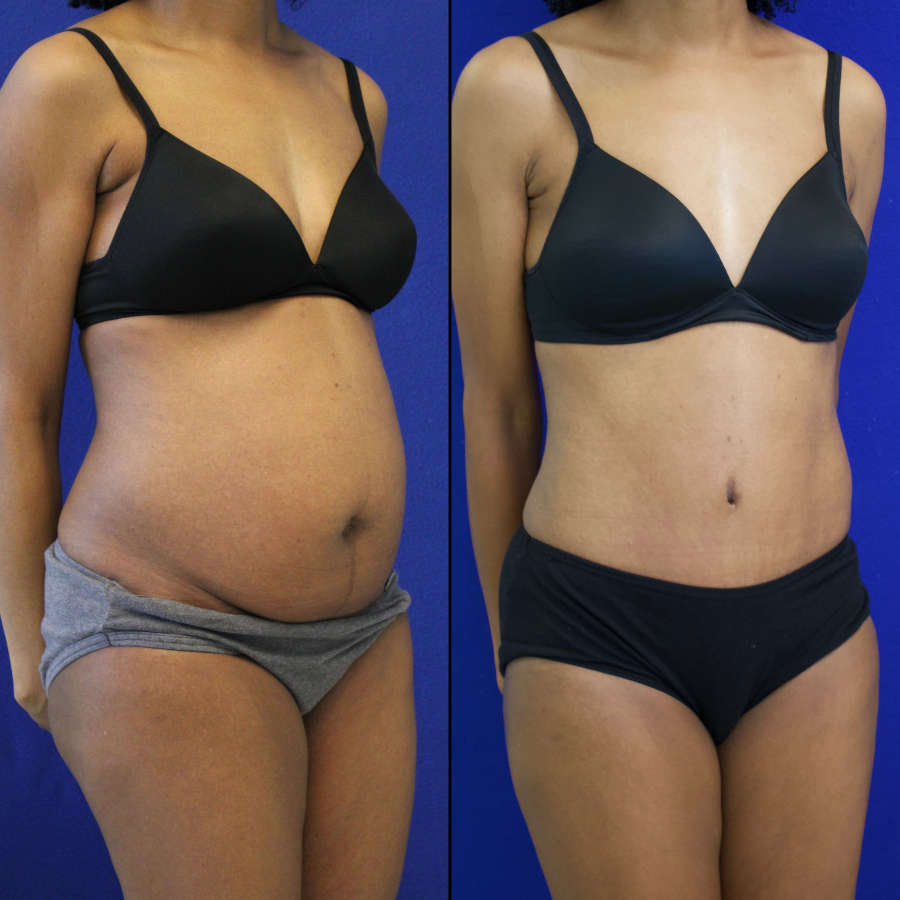 53 year-old patient before and after-abdominoplasty and flanks liposuction.