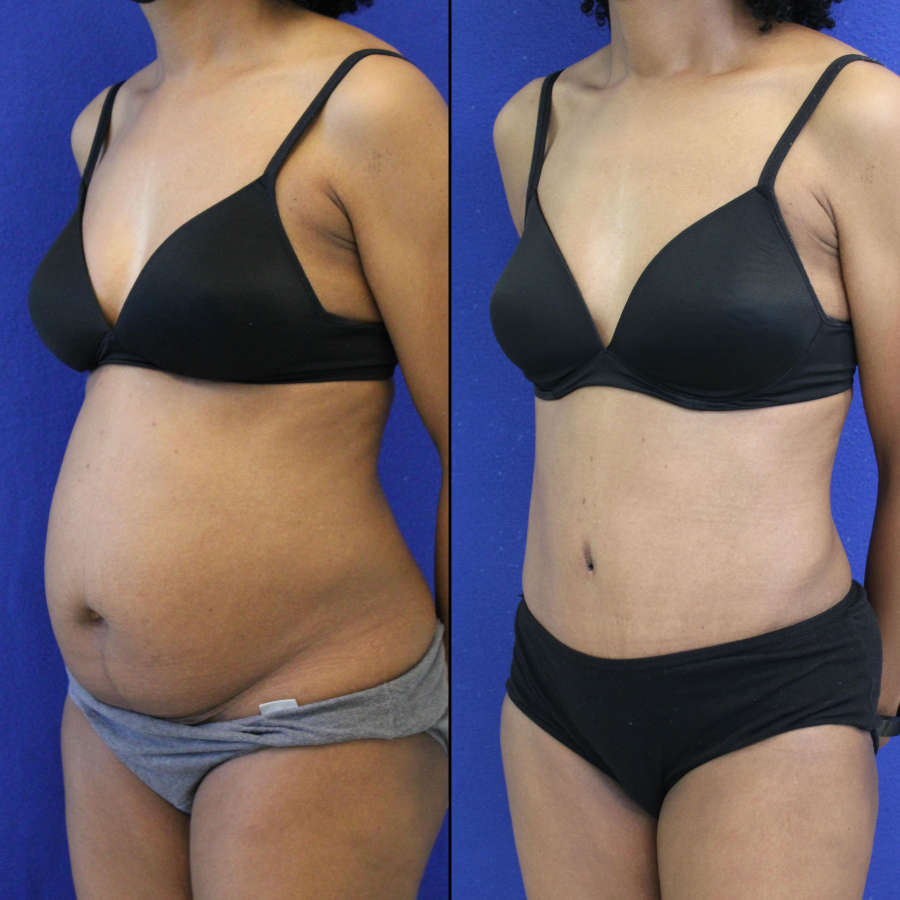 53 year-old patient before and after-abdominoplasty and flanks liposuction.