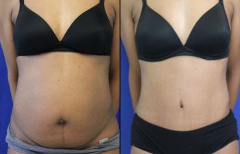 53 year-old patient before and after-abdominoplasty and flanks liposuction.