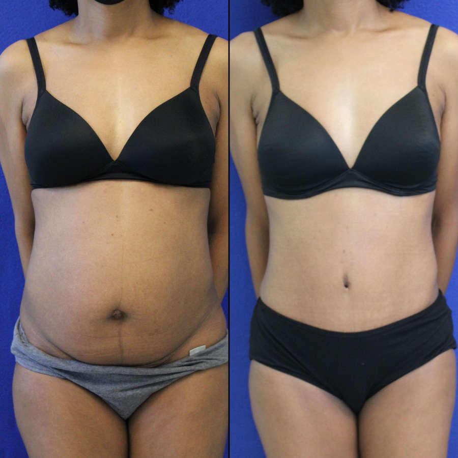 53 year-old patient before and after-abdominoplasty and flanks liposuction.