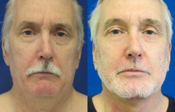 59 year-old patient before and after neck lift, mini facelift and chin augmentation