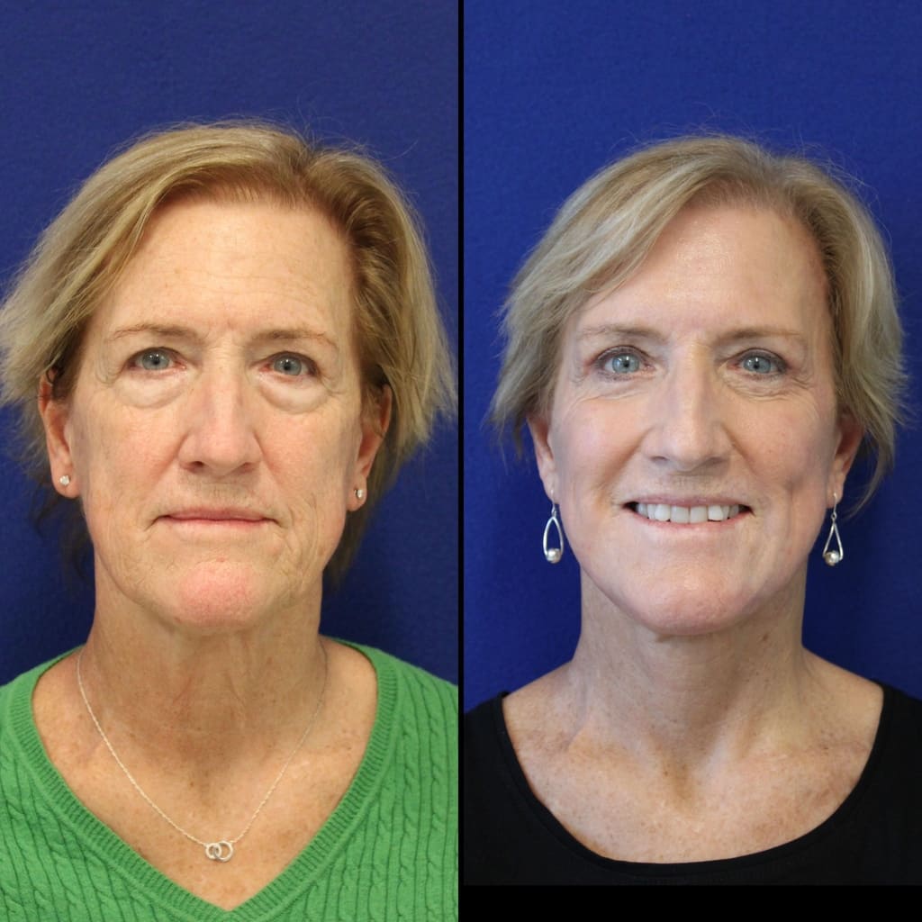 63 year-old patient before and after facelift, neck lift, lower and upper blepharoplasty, brow lift, canthopexy, fat grafting and CO2 laser