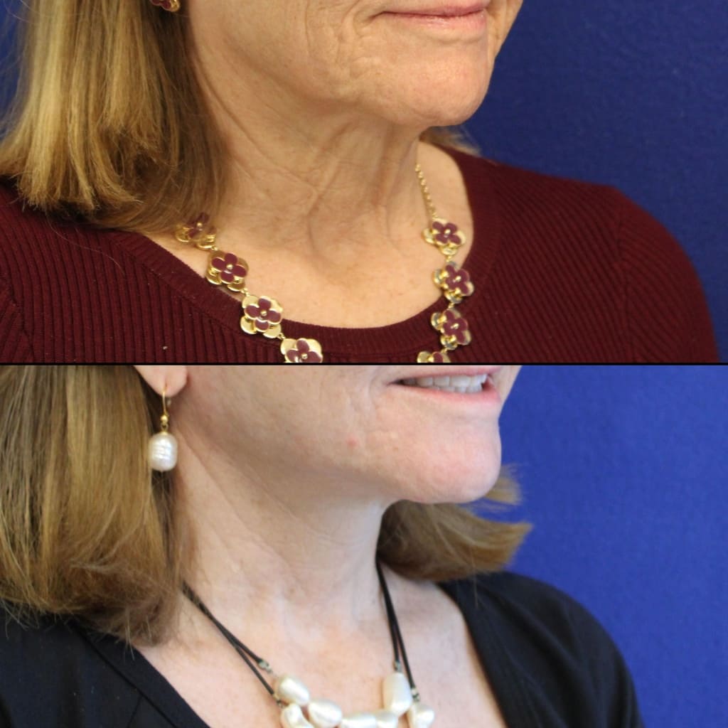 64 year-old patient before after facelift, neck lift, lower and upper blepharoplasty, canthopexy, CO2 laser