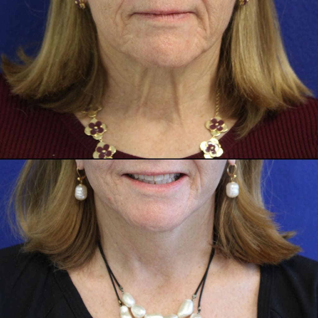 64 year-old patient before after facelift, neck lift, lower and upper blepharoplasty, canthopexy, CO2 laser