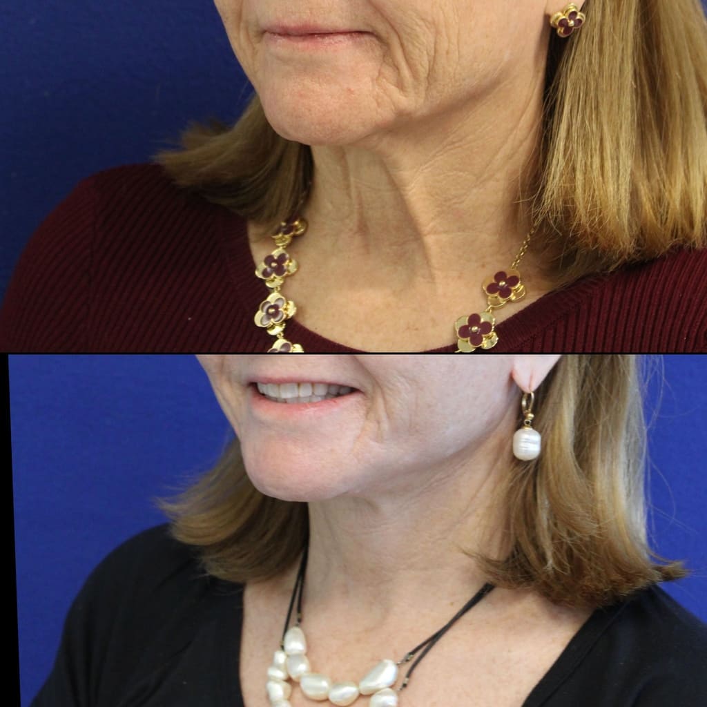 64 year-old patient before after facelift, neck lift, lower and upper blepharoplasty, canthopexy, CO2 laser