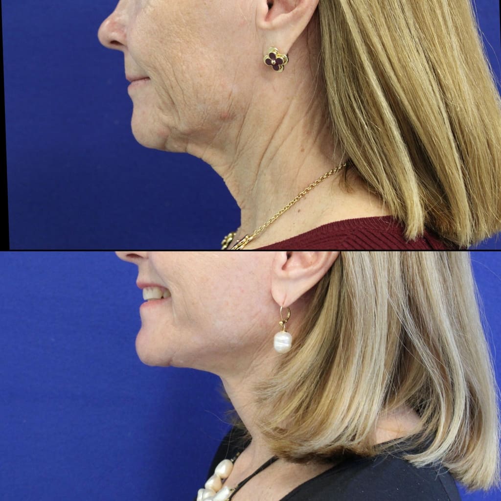 64 year-old patient before after facelift, neck lift, lower and upper blepharoplasty, canthopexy, CO2 laser