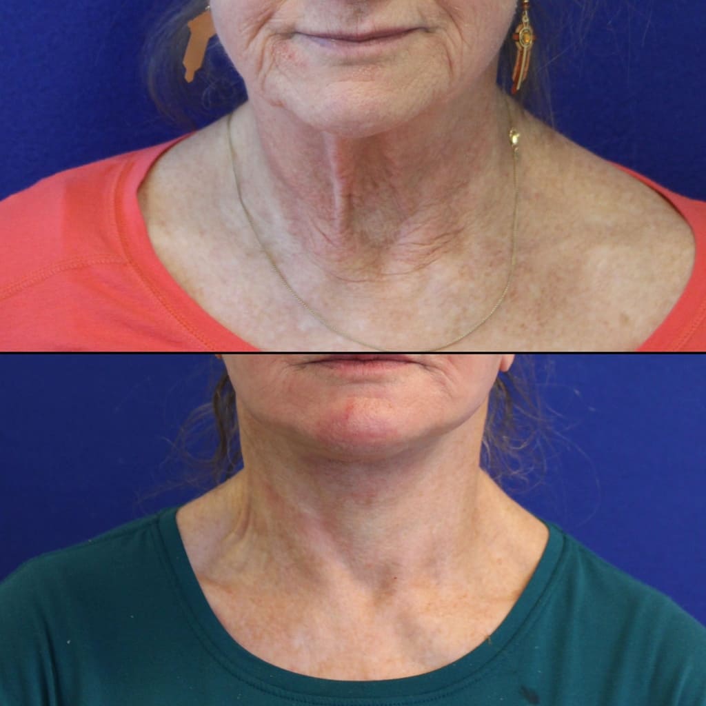 70 year-old patient before and 2 weeks after facelift, neck lift, lower and upper blepharoplasty, brow lift, canthopexy, fat grafting, lip lift and CO2 laser