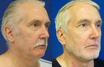 59 year-old patient before and after neck lift, mini facelift and chin augmentation