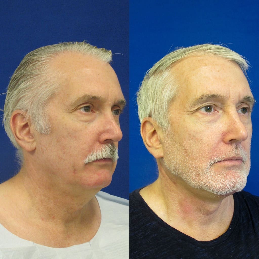 59 year-old patient before and after neck lift, mini facelift and chin augmentation