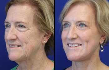 63 year-old patient before and after facelift, neck lift, lower and upper blepharoplasty, brow lift, canthopexy, fat grafting and CO2 laser