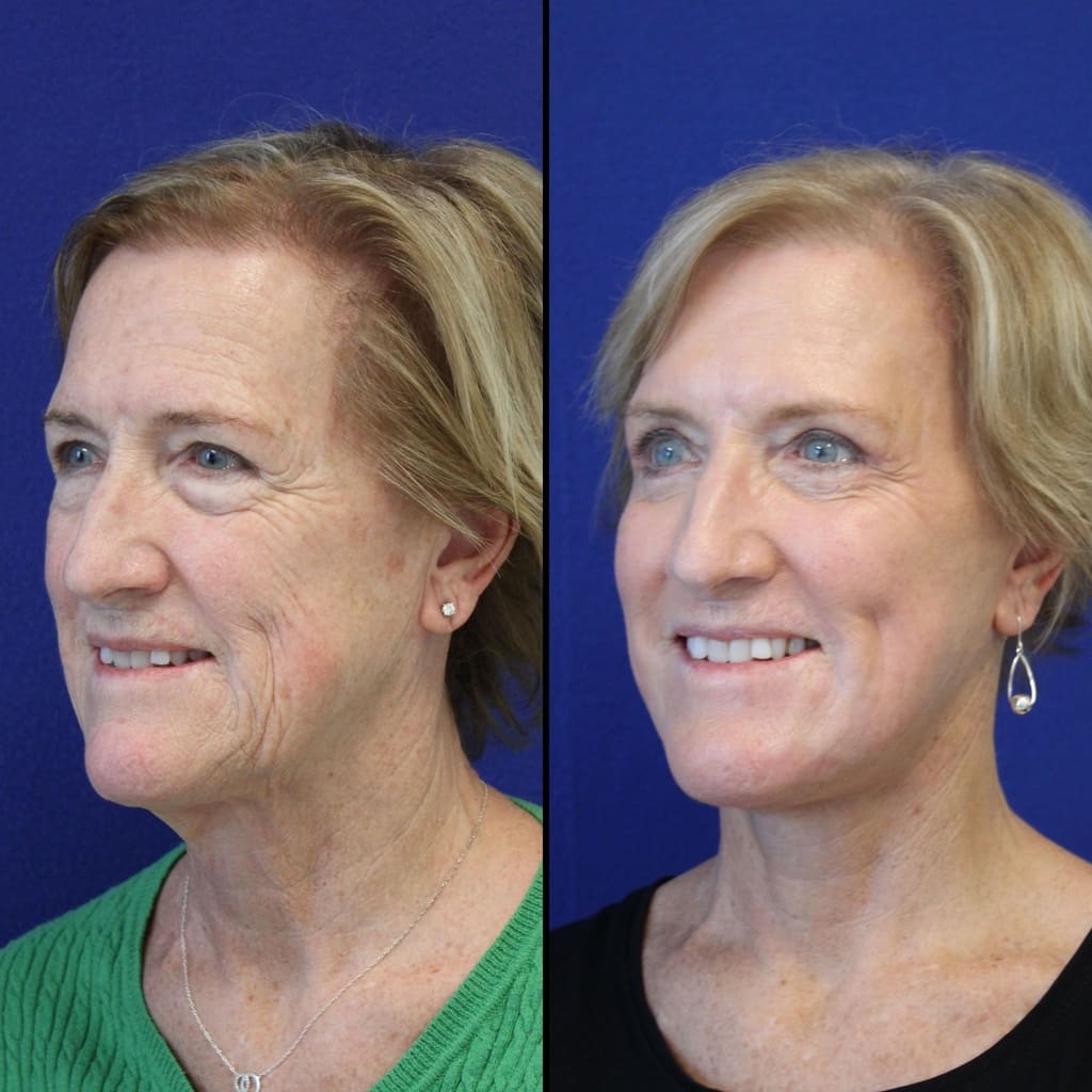 63 year-old patient before and after facelift, neck lift, lower and upper blepharoplasty, brow lift, canthopexy, fat grafting and CO2 laser