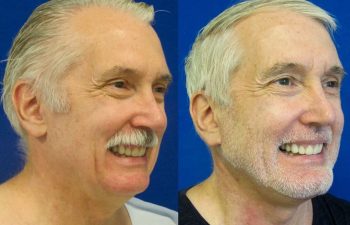 59 year-old patient before and after neck lift, mini facelift and chin augmentation