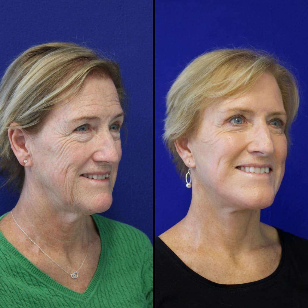63 year-old patient before and after facelift, neck lift, lower and upper blepharoplasty, brow lift, canthopexy, fat grafting and CO2 laser
