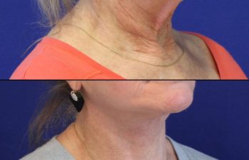 70 year-old patient before and 2 weeks after facelift, neck lift, lower and upper blepharoplasty, brow lift, canthopexy, fat grafting, lip lift and CO2 laser