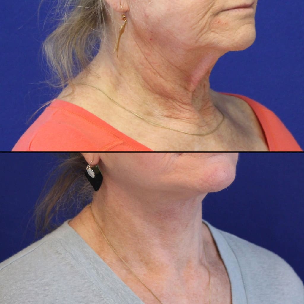70 year-old patient before and 2 weeks after facelift, neck lift, lower and upper blepharoplasty, brow lift, canthopexy, fat grafting, lip lift and CO2 laser