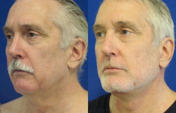 59 year-old patient before and after neck lift, mini facelift and chin augmentation