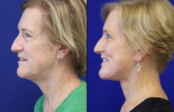 63 year-old patient before and after facelift, neck lift, lower and upper blepharoplasty, brow lift, canthopexy, fat grafting and CO2 laser