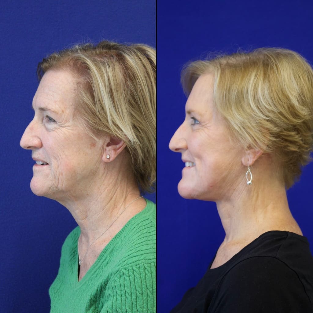 63 year-old patient before and after facelift, neck lift, lower and upper blepharoplasty, brow lift, canthopexy, fat grafting and CO2 laser
