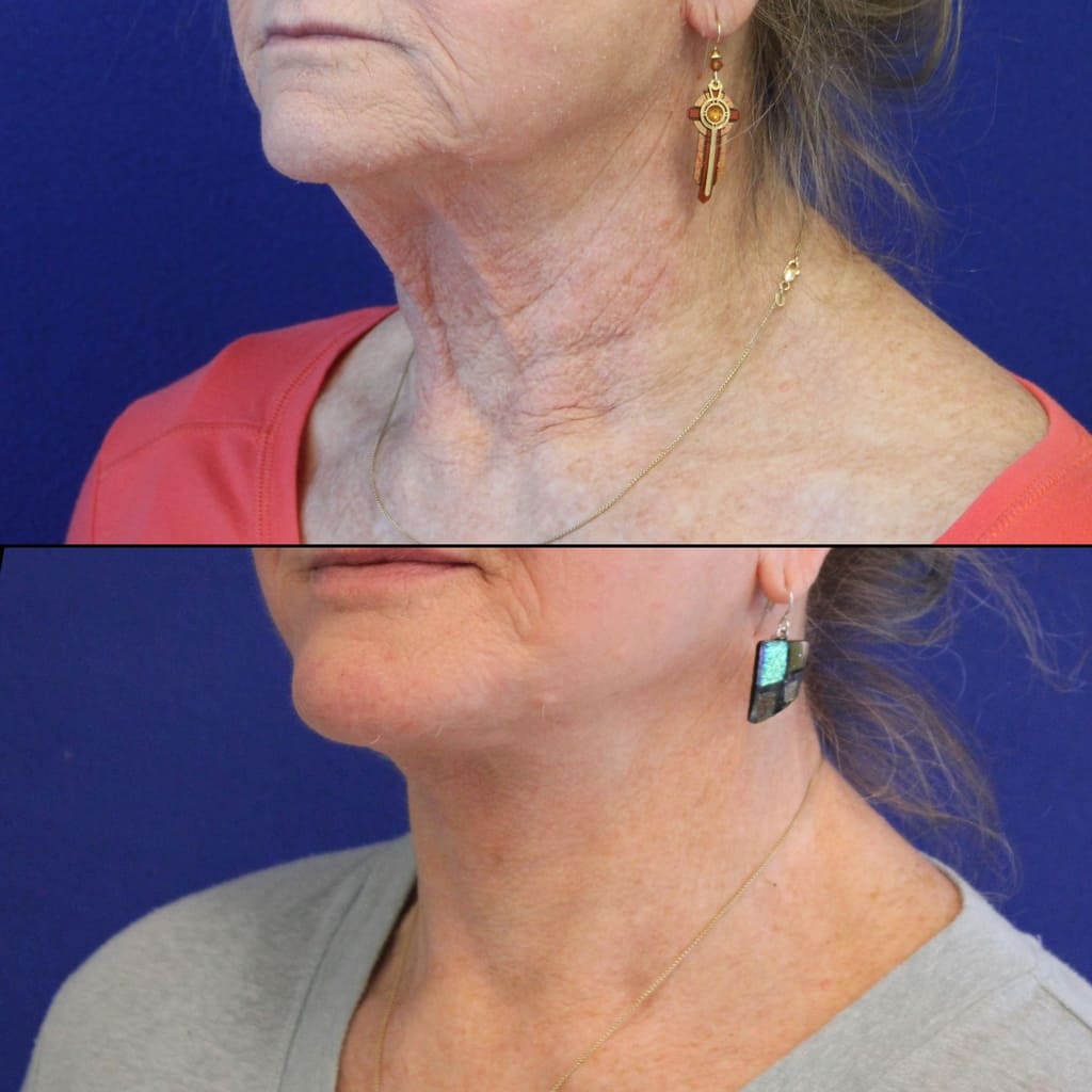 70 year-old patient before and 2 weeks after facelift, neck lift, lower and upper blepharoplasty, brow lift, canthopexy, fat grafting, lip lift and CO2 laser