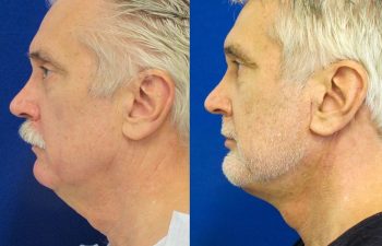 59 year-old patient before and after neck lift, mini facelift and chin augmentation