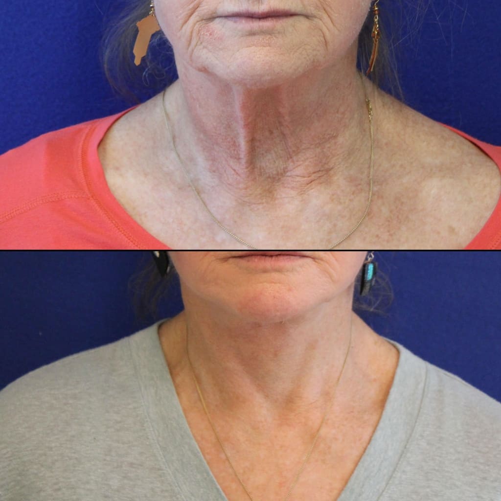 70 year-old patient before and 2 weeks after facelift, neck lift, lower and upper blepharoplasty, brow lift, canthopexy, fat grafting, lip lift and CO2 laser