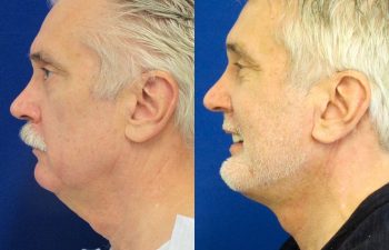 59 year-old patient before and after neck lift, mini facelift and chin augmentation