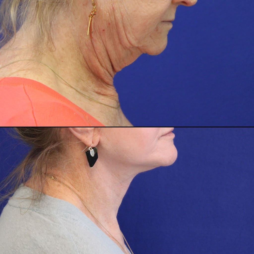 70 year-old patient before and 2 weeks after facelift, neck lift, lower and upper blepharoplasty, brow lift, canthopexy, fat grafting, lip lift and CO2 laser