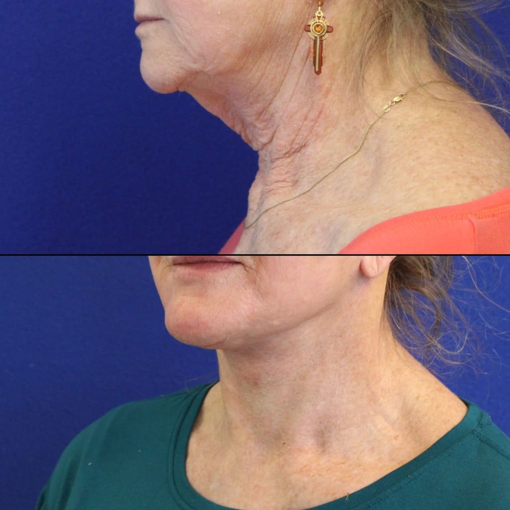 70 year-old patient before and 2 weeks after facelift, neck lift, lower and upper blepharoplasty, brow lift, canthopexy, fat grafting, lip lift and CO2 laser