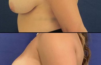 patient before and after breast reduction