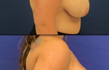 patient before and after breast reduction
