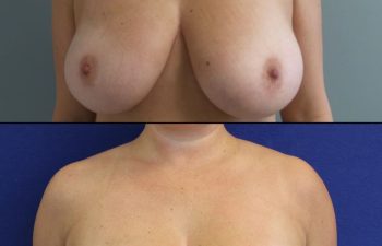 patient before and after breast reduction